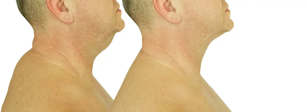 Muž s vdovským hrbem před a po léčbě - profilové fotky.