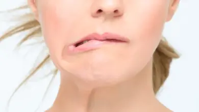 Žena s paralýzou obličeje, klesající ústa a asymetrie tváře.