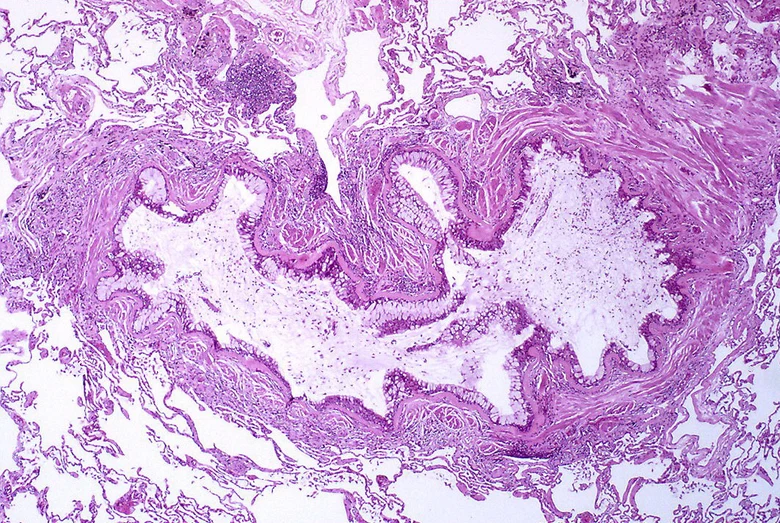 Bronchial tissue histology