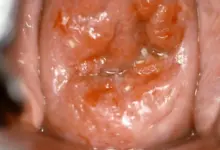 Fotografie hrdla s viditelnými příznaky infekce virem HPV.