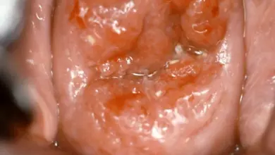 Fotografie hrdla s viditelnými příznaky infekce virem HPV.