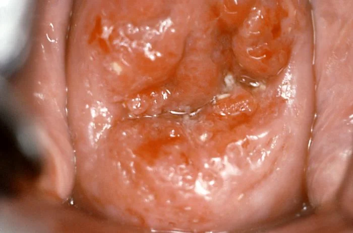 Fotografie hrdla s viditelnými příznaky infekce virem HPV.