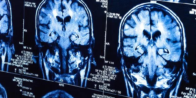 Magnetická rezonance mozku pro diagnostiku nádorů