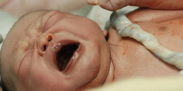 Novorozenec pláč s viditelnou vrstvou vernixu na kůži.