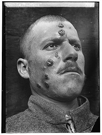Man with leishmaniasis lesions