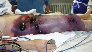 Nekrotická noha s aplikací odsávacích váčků při léčbě